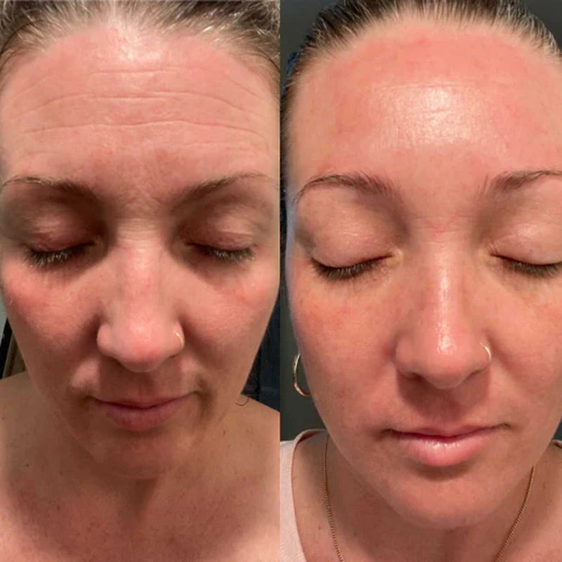 Forehead & between Eyes Facial Patches