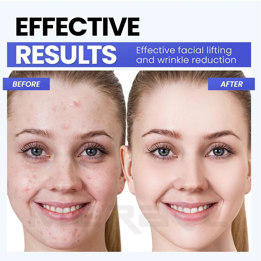 Face Lifting Device EMS Face Massager Skin Tightening