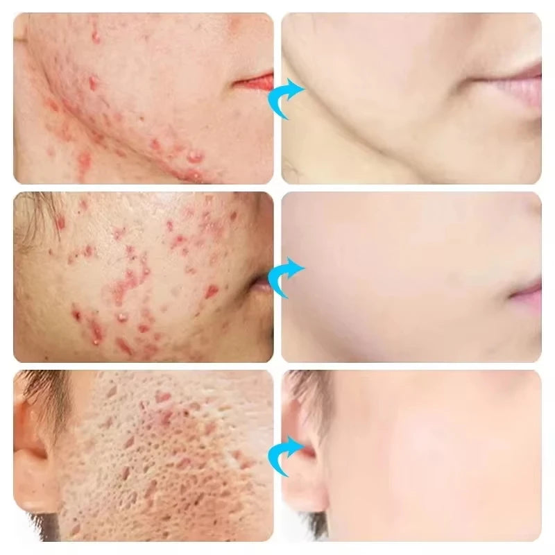 Herbal Acne Removal Face Cream Clears Pimple Scar Black Dots Gel Acne Treatment Shrink Pore Skin Whitening Lightening Ointment