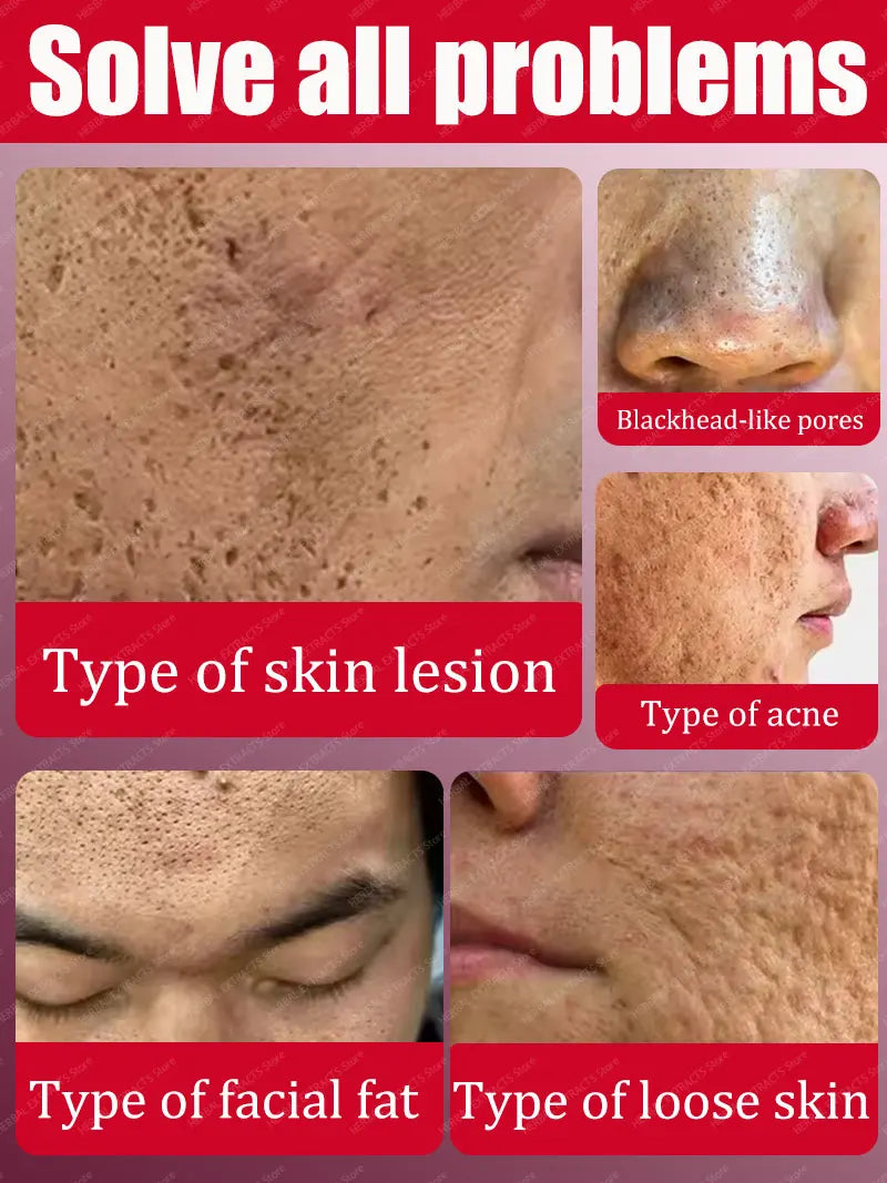 Solve your large pore problem