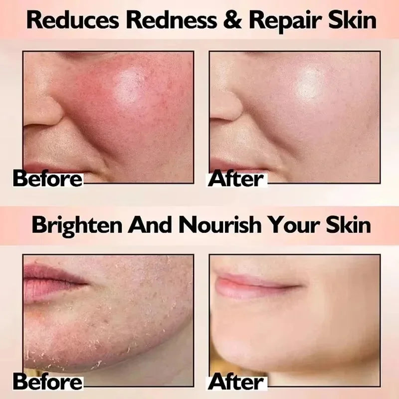 Facial Redness Repair Cream Improve Sensitive Skin Moisturizer Hydrate Sooth Lotion Removal Rosacea Spider Vein Korean Cosmetic
