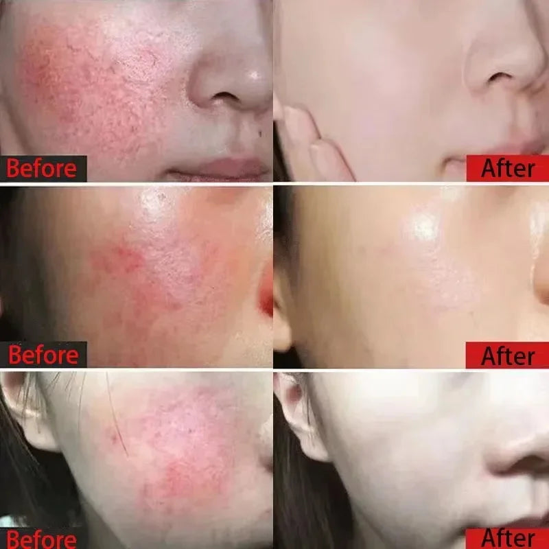 Facial Redness Repair Cream Improve Sensitive Skin Moisturizer Hydrate Sooth Lotion Removal Rosacea Spider Vein Korean Cosmetic