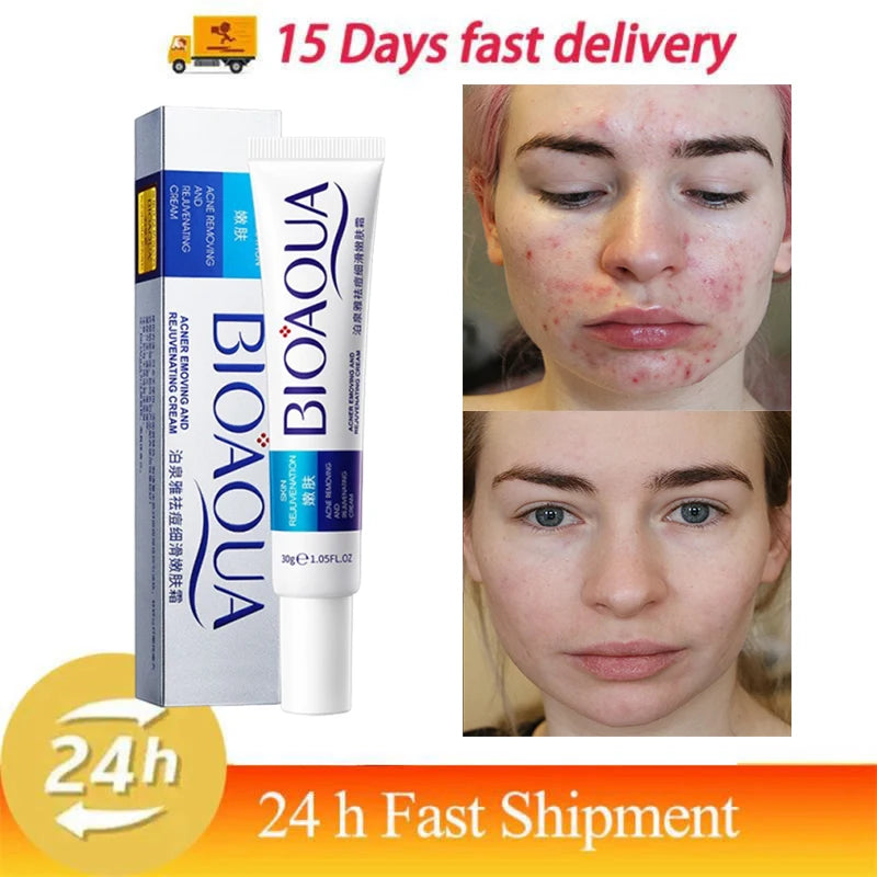 Herbal Acne Removal Face Cream Clears Pimple Scar Black Dots Gel Acne Treatment Shrink Pore Skin Whitening Lightening Ointment